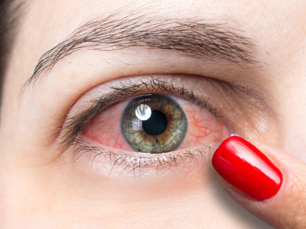 Conjunctivitis or Pink Eye  Causes, Symptoms and Prevention